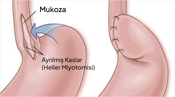 Akalazya Tedavisi