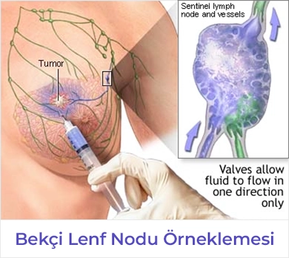 Bekçi Lenf Nodu Örneklemesi 