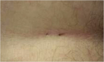 Pilonidal Kist